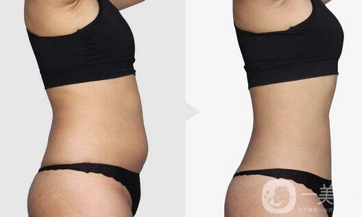 南京吸脂減肥的價(jià)格是多少？吸脂減肥大概多少錢？