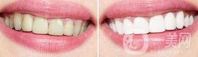 皓齒美白牙齒,多少錢