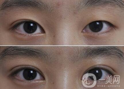 韓式三點雙眼皮能拆嗎？**果怎么樣？