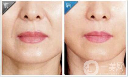 自體脂肪豐鼻唇溝*果怎么樣?自體脂肪填充鼻唇溝詳細(xì)介紹