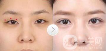 韓式三點(diǎn)雙眼皮是埋線還是割？手術(shù)*果怎么樣
