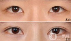 高分子埋線是*的嗎？可以維持幾年？