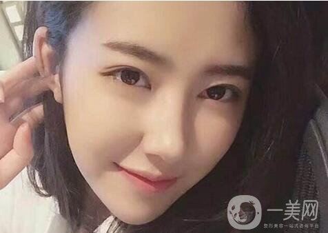 非手術(shù)隆鼻多少錢 非手術(shù)隆鼻價格介紹