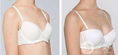 曼托,假體豐胸,費用