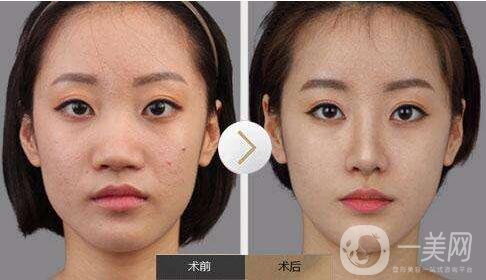 鼻頭縮小手術(shù),多少錢