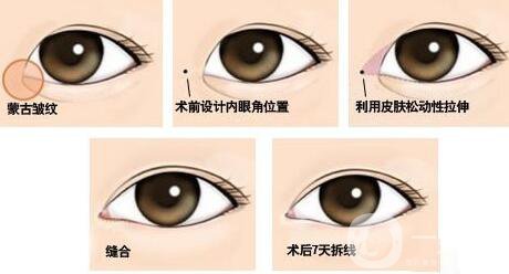 開眼角*果有哪些、開眼角手術(shù)的*果怎么樣？