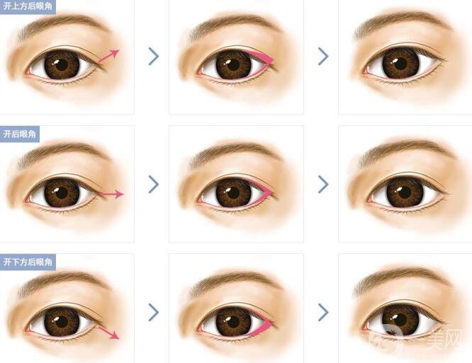 開眼角*果有哪些、開眼角手術(shù)的*果怎么樣？
