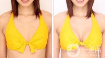 曼托假體隆胸手術(shù)有風(fēng)險(xiǎn)嗎？曼托假體隆胸后遺癥介紹