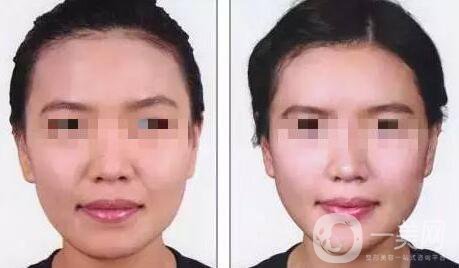 自體脂肪豐鼻唇溝有什么優(yōu)勢(shì)？*果怎么樣呢？