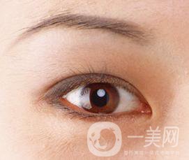 生物焊接雙眼皮是什么？有什么特點(diǎn)？