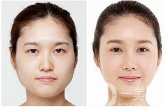 生物焊接雙眼皮是什么？有什么特點(diǎn)？