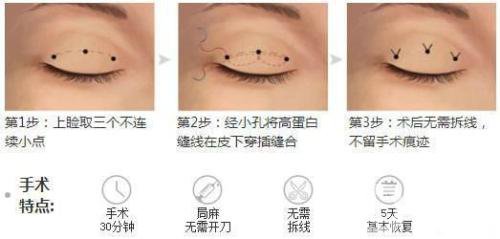 三點式雙眼皮*果一般能撐幾年？