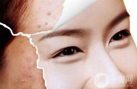 光子嫩膚能去痘印嗎、光子嫩膚去痘印*果怎么樣？