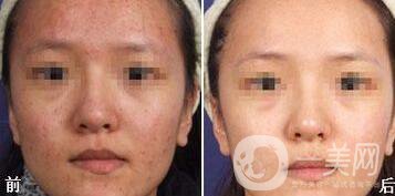 光子嫩膚能去痘印嗎、光子嫩膚去痘印*果怎么樣？