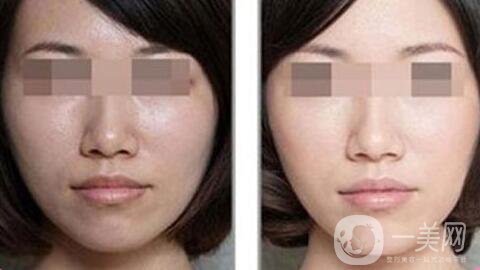 光子嫩膚做一次多少錢、光子嫩膚價格詳解