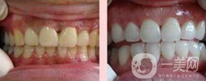 四環(huán)素牙如何變白、四環(huán)素牙怎么調(diào)節(jié)？