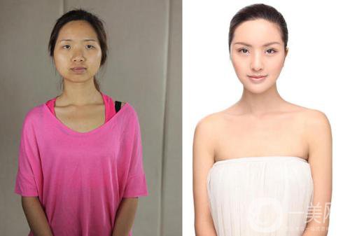 光子嫩膚有些什么*果和好處？