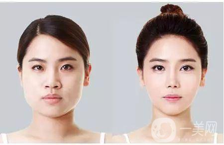 注射*大概需要多少錢(qián)？