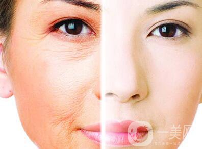 光子嫩膚的*果如何、光子嫩膚到底怎么樣？