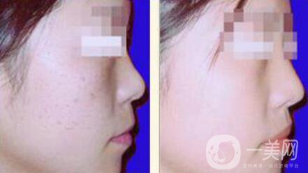 光子嫩膚的*果如何、光子嫩膚到底怎么樣？