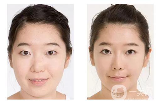 注射*的注意事項有些什么？