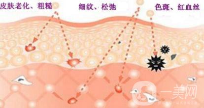 做光子嫩膚有什么作用和好處？