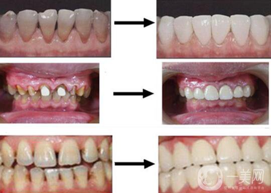 烤瓷牙的材料有哪些？烤瓷牙*果如何