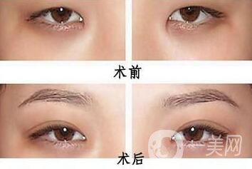 韓式開眼角哪*果好？哪個(gè)醫(yī)院做韓式開眼角比較好