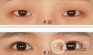 韓式開眼角哪*果好？哪個(gè)醫(yī)院做韓式開眼角比較好