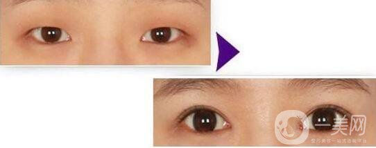 開眼角的*果到底怎么樣？開眼角前后圖