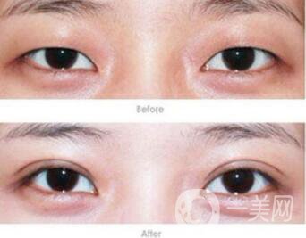 焊接雙眼皮*果怎么樣？焊接雙眼皮有什么缺點(diǎn)