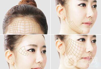 *面部提升術(shù)詳細(xì)介紹？**果怎么樣