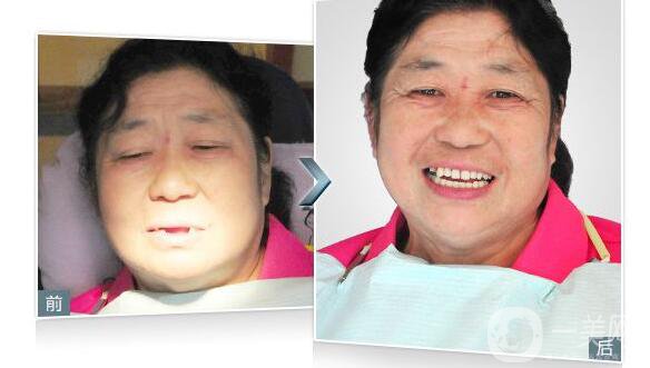 深圳,種植牙,價(jià)格