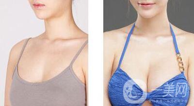 2c雙平面豐胸,多少錢