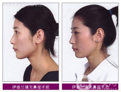 伊維蘭除皺多少錢 價格是多少？