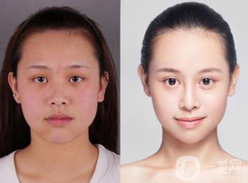 微創(chuàng)改臉型多少錢 費用詳情介紹