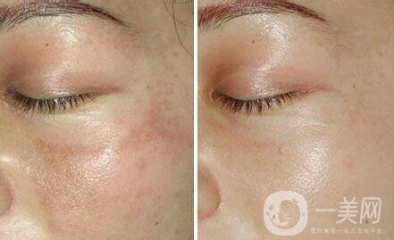 如何去蝴蝶斑、去蝴蝶斑用什么方法好？