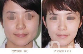 *一針要多少錢 正規(guī)醫(yī)院*價(jià)格貴嗎