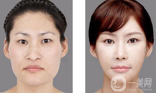 做改臉型要多少錢 做改臉型價格盤點