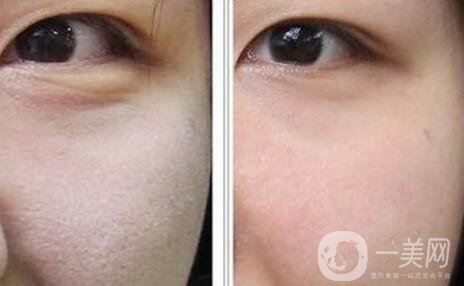 做完光子嫩膚要怎么護(hù)理 光子嫩膚后注意事項(xiàng)介紹