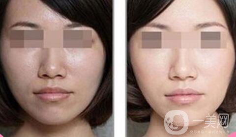 做完光子嫩膚要怎么護(hù)理 光子嫩膚后注意事項(xiàng)介紹