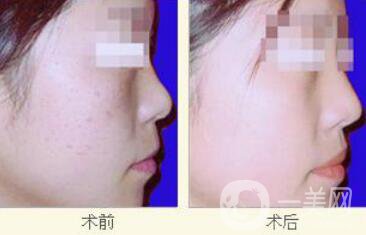 光子嫩膚價(jià)格是多少 光子嫩膚多少錢一次