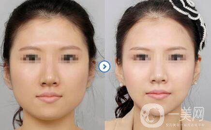 切咬肌多少錢？還會(huì)長(zhǎng)出來(lái)嗎？