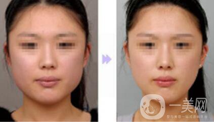 切咬肌多少錢？還會(huì)長(zhǎng)出來(lái)嗎？