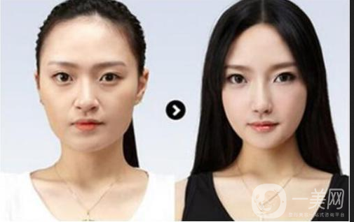 做完墊鼻梁硅膠*果能堅持幾年？