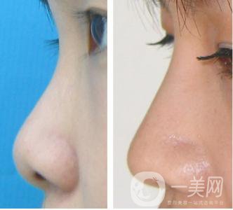 耳軟骨墊鼻尖手術(shù)做完需要多久恢復(fù)正常？