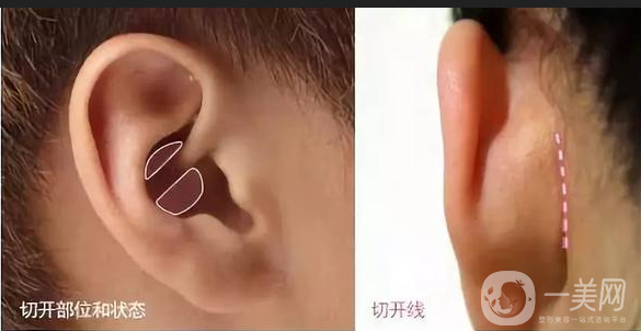 耳軟骨墊鼻尖手術(shù)做完需要多久恢復(fù)正常？