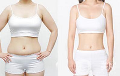 北京吸脂瘦腰減肥手術(shù)價錢是多少 價格一覽