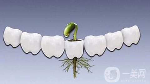 做一次種植牙的價格 費用貴嗎？