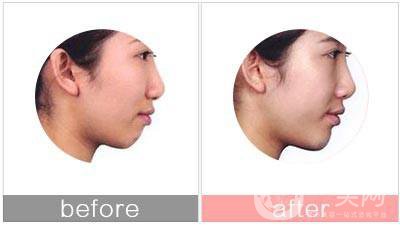 硅膠假體隆下巴手術(shù)多少錢 收費(fèi)情況一覽